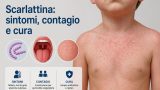 Scarlattina: sintomi, contagio, cura e tutto quello che i genitori devono sapere